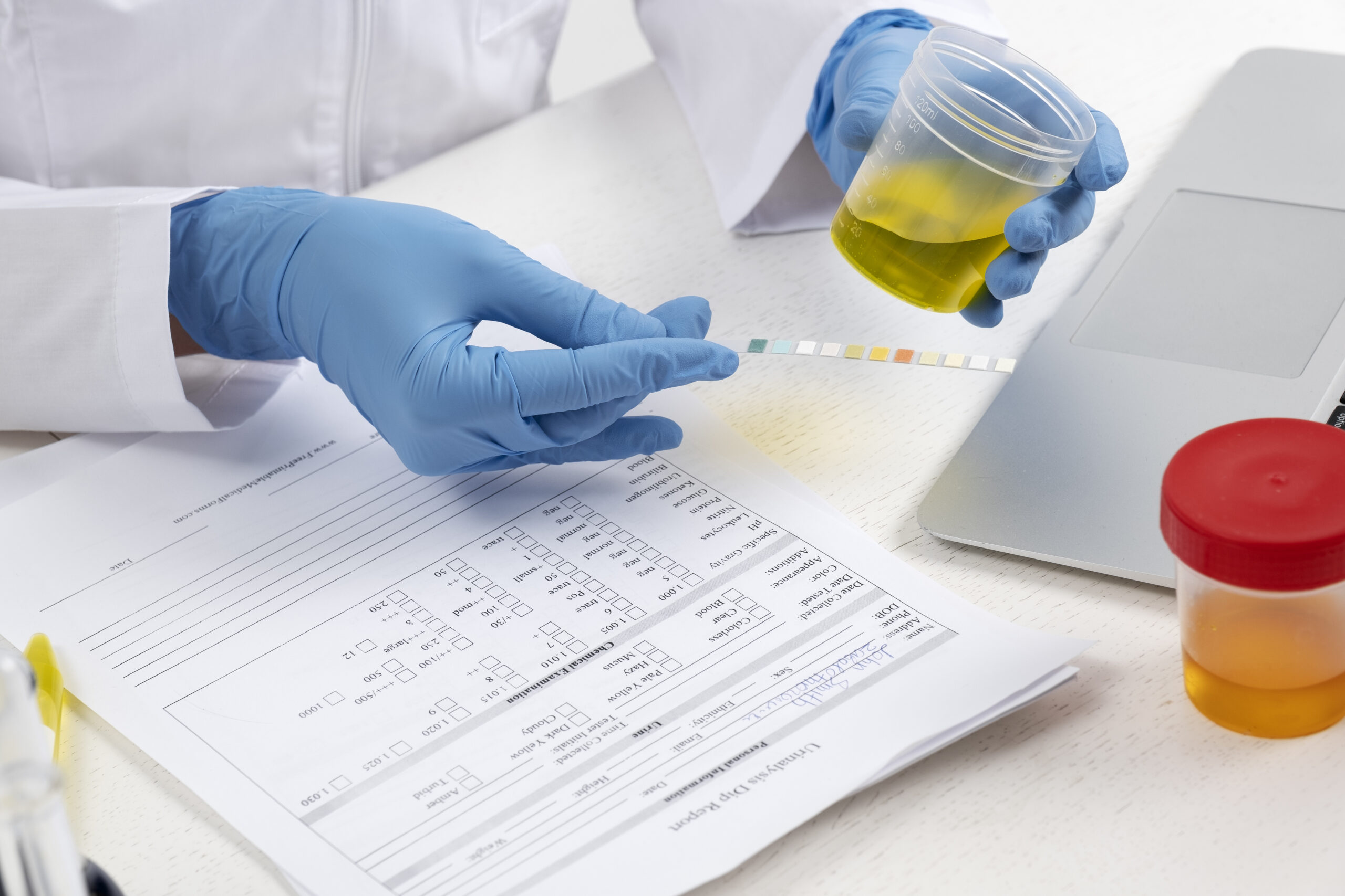 SNP How to reduce Creatinine level?