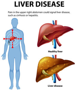 liver disease