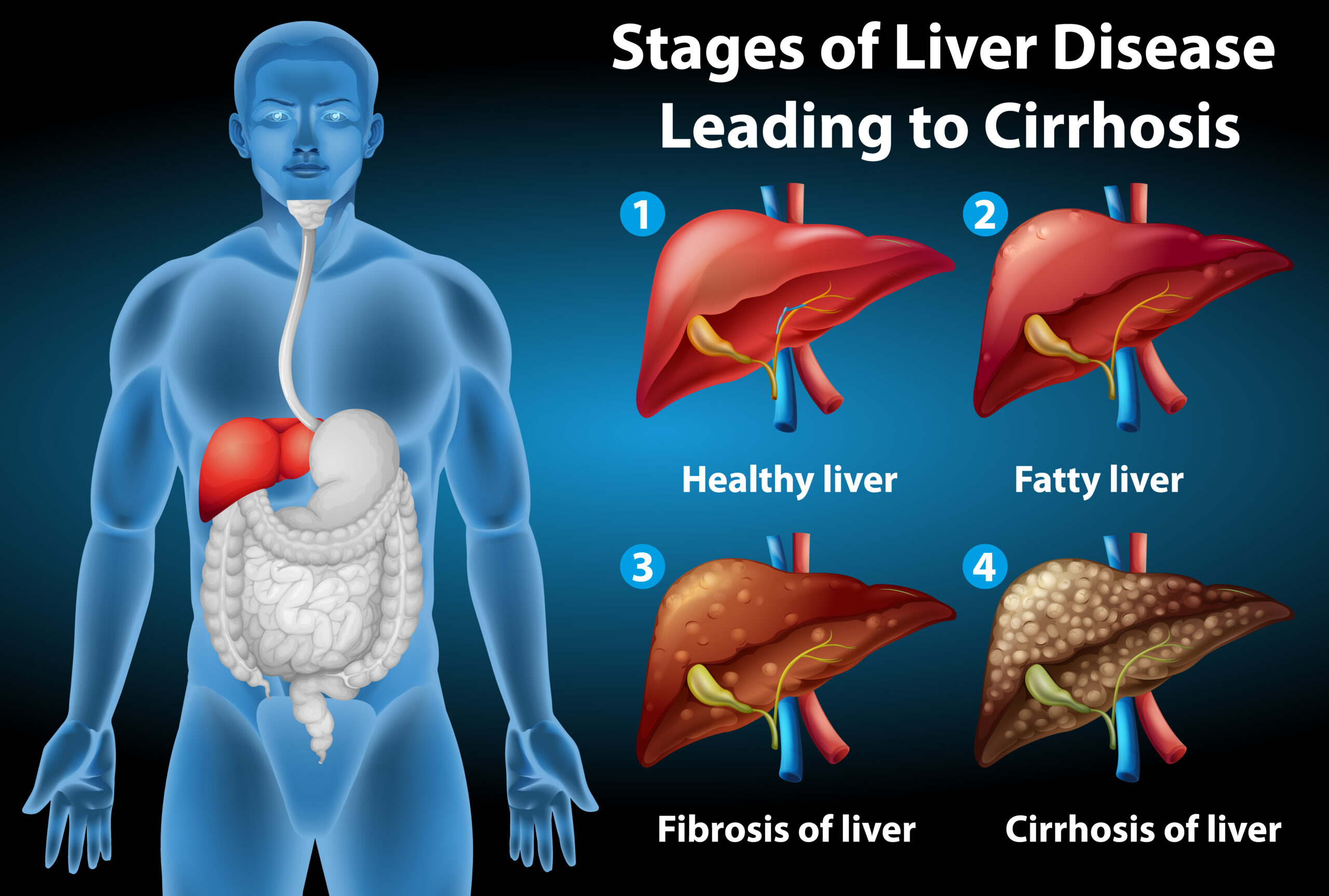 snp liver diesease stages